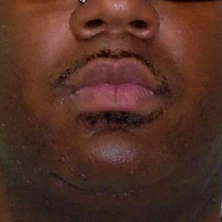 Chin Before & After Patient #299