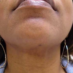 Chin Before & After Patient #308