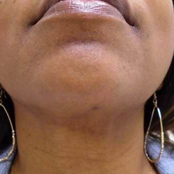 Chin Before & After Patient #308