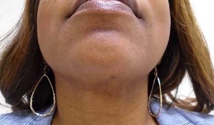 Chin Before & After Patient #308
