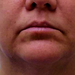 Chin Before & After Patient #272