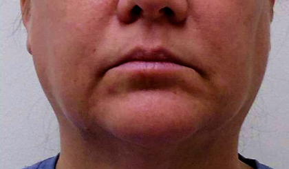 Chin Before & After Patient #272