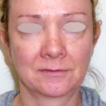 Chin Before & After Patient #275