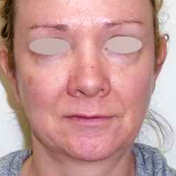 Chin Before & After Patient #275