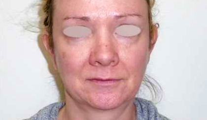 Chin Before & After Patient #275