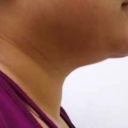 Chin Before & After Patient #278