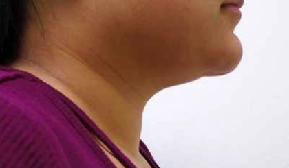 Chin Before & After Patient #278