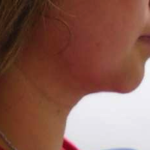 Chin Before & After Patient #284
