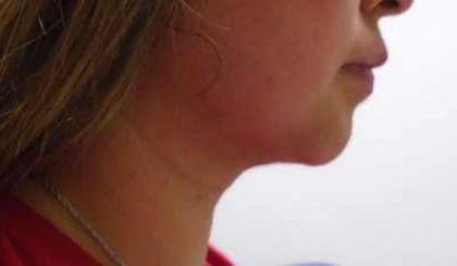Chin Before & After Patient #284