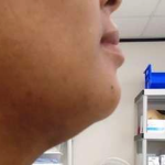 Chin Before & After Patient #287