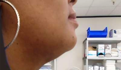 Chin Before & After Patient #287