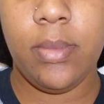 Chin Before & After Patient #296