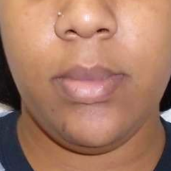 Chin Before & After Patient #296