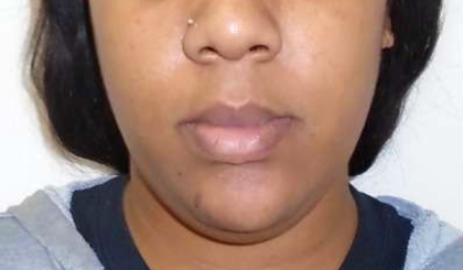 Chin Before & After Patient #296