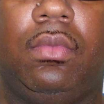 Chin Before & After Patient #299