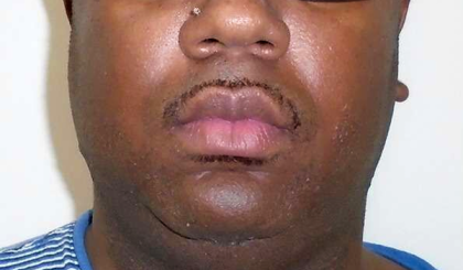 Chin Before & After Patient #299