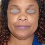 Chin Before & After Patient #302
