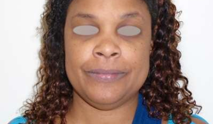 Chin Before & After Patient #302