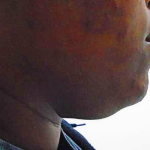Chin Before & After Patient #305