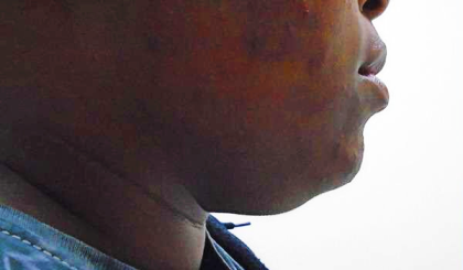 Chin Before & After Patient #305