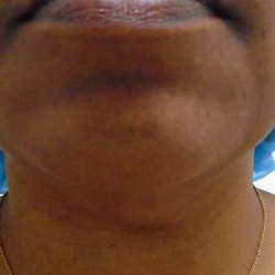 Chin Before & After Patient #308
