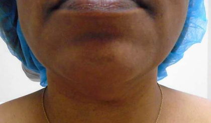 Chin Before & After Patient #308