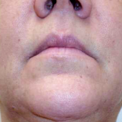 Chin Before & After Patient #272