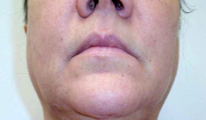 Chin Before & After Patient #272