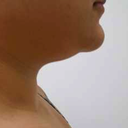 Chin Before & After Patient #278