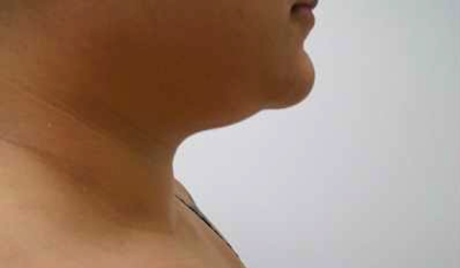 Chin Before & After Patient #278