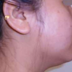 Chin Before & After Patient #281