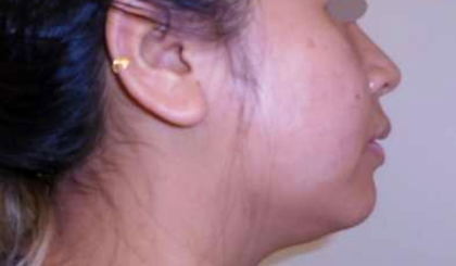 Chin Before & After Patient #281