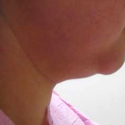 Chin Before & After Patient #284