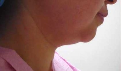 Chin Before & After Patient #284
