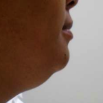 Chin Before & After Patient #287