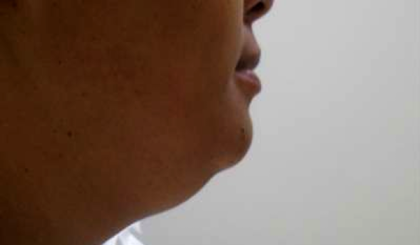 Chin Before & After Patient #287