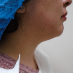 Chin Before & After Patient #290