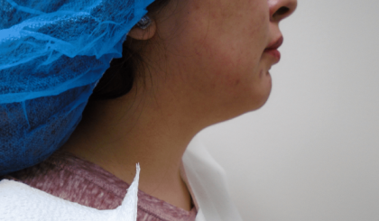 Chin Before & After Patient #290