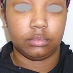 Chin Before & After Patient #293