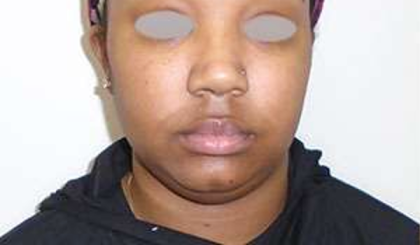 Chin Before & After Patient #293
