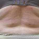 Flanks Before & After Patient #311