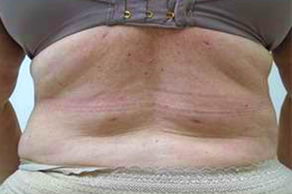 Flanks Before & After Patient #311