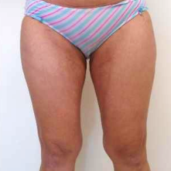 Inner Thigh Before & After Patient #314