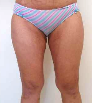 Inner Thigh Before & After Patient #314