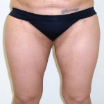 Inner Thigh Before & After Patient #317