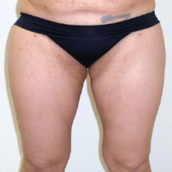 Inner Thigh Before & After Patient #317