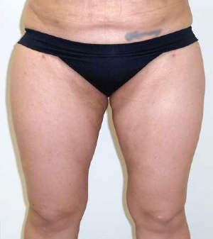 Inner Thigh Before & After Patient #317