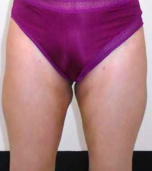 Inner Thigh Before & After Patient #320