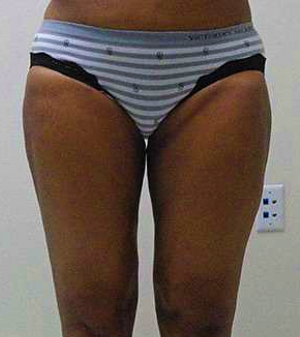 Inner Thigh Before & After Patient #323