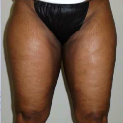 Inner Thigh Before & After Patient #326